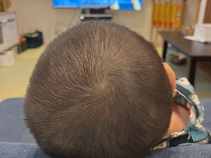 【プールの時期は要注意】体験談！子どもがアタマシラミになっちゃった！