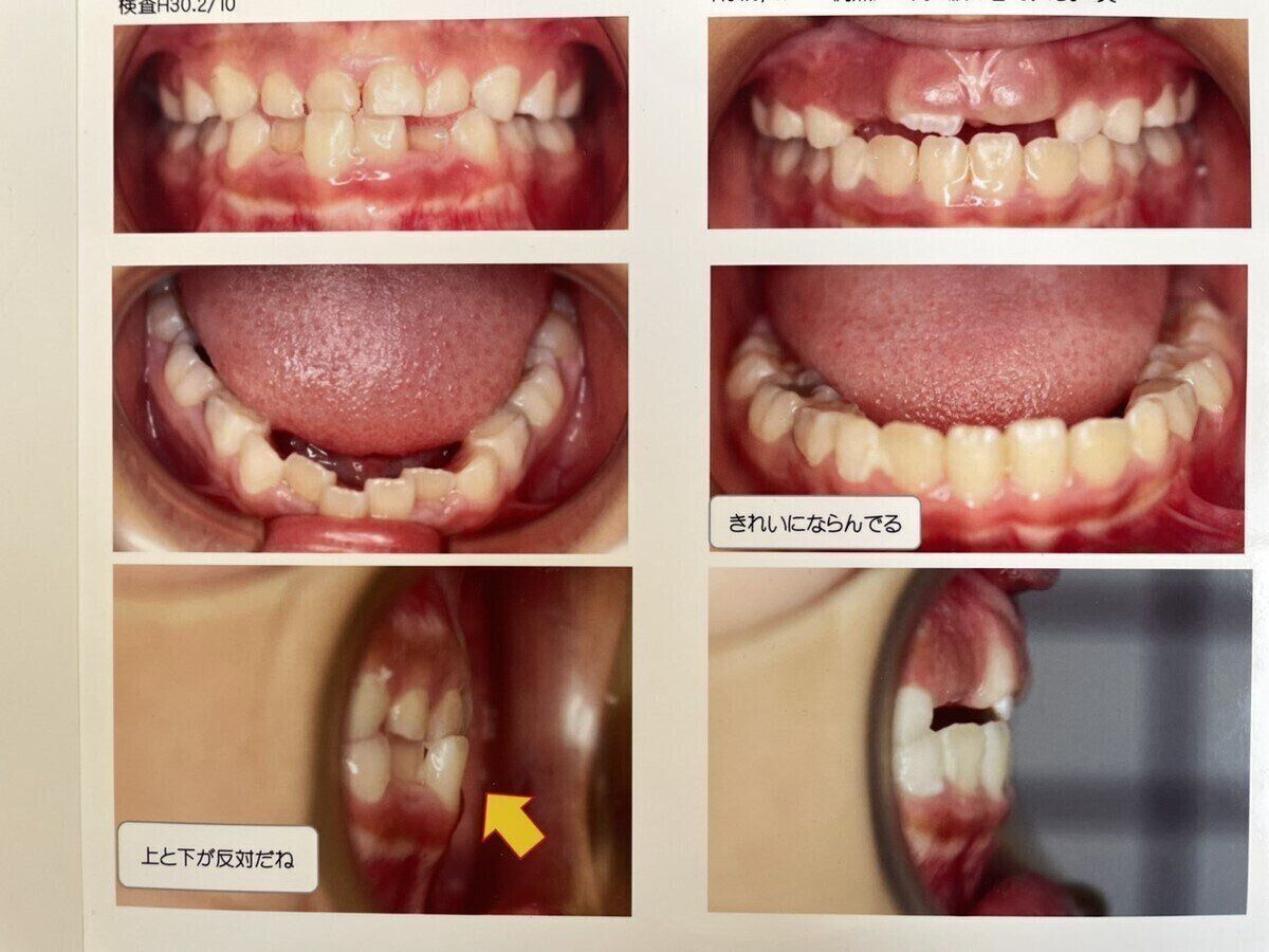 小児矯正のリアルなお金事情！初期費用とメンテナンスの内訳は？効果は？4年間まとめ