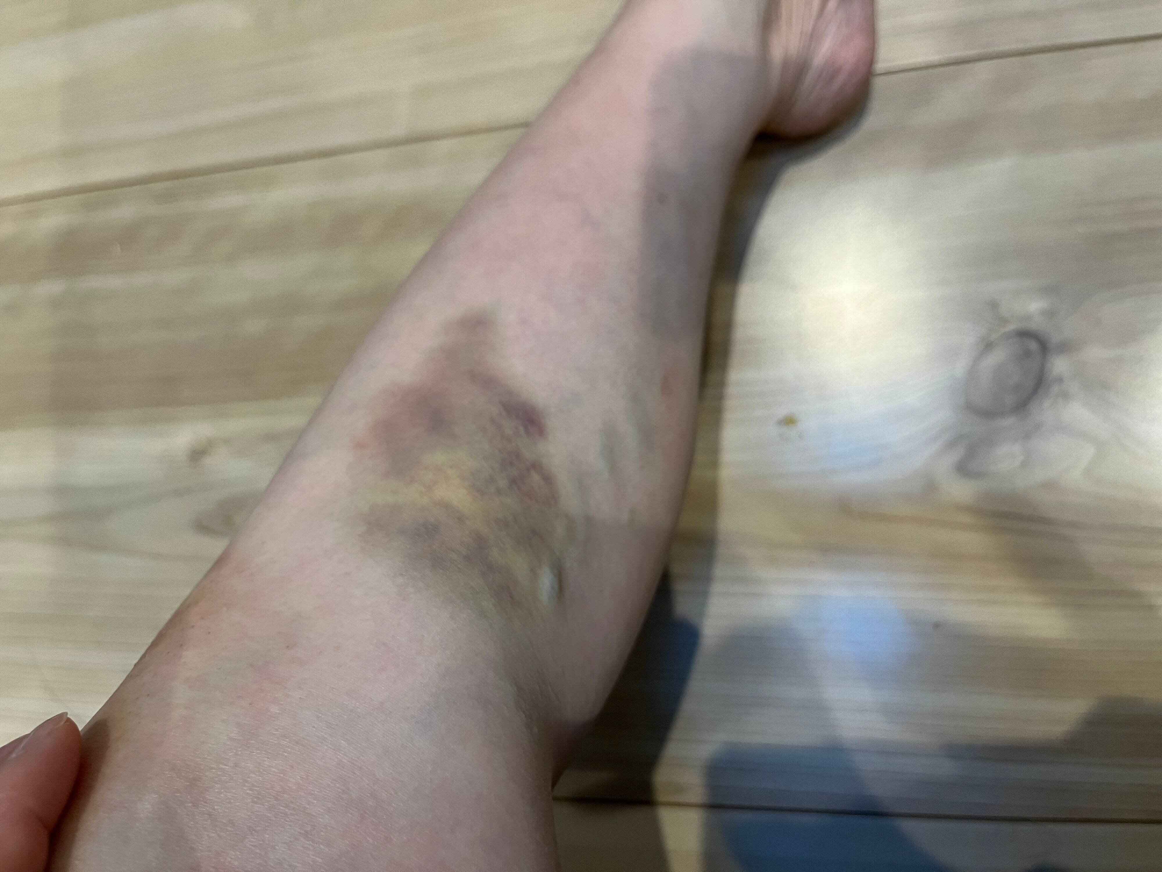 子どもを乗せた電動自転車で大転倒！二度と起こらないために