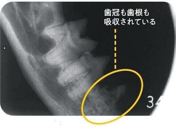 歯の吸収病巣タイプ2