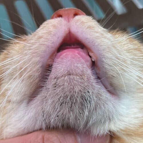 あごニキビとは