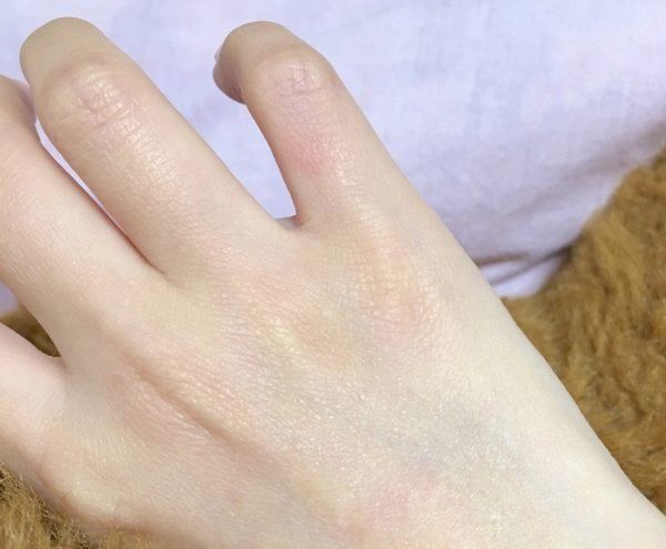 起きたら手が赤くなっていた飼い主さん