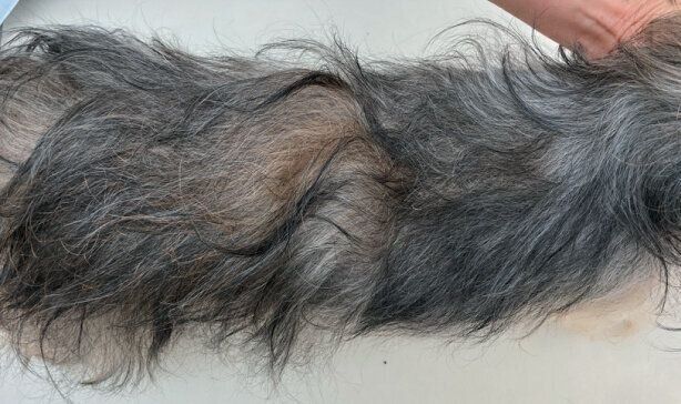 多汗症の症例写真