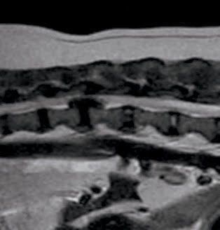 ヘルニアMRI写真