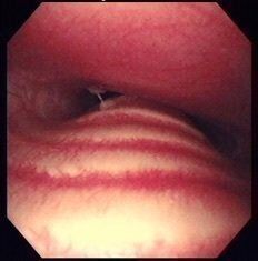 気管虚脱の症例写真