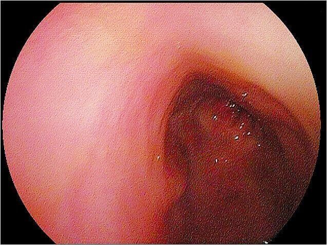 健康な状態の大腸の内視鏡画像。腸壁は淡いピンク色で、なめらかな状態です