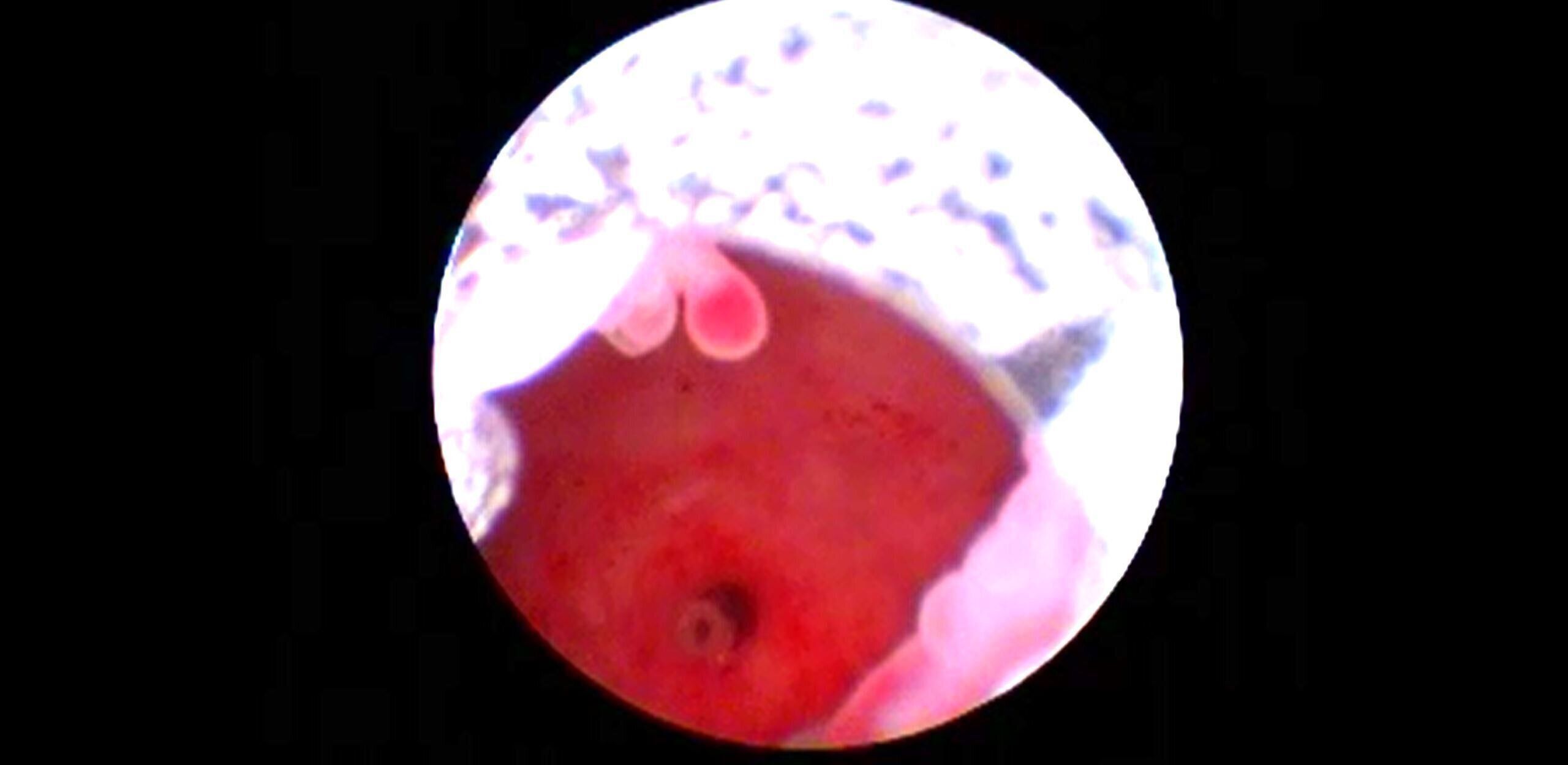 中央でさくらんぼのような形をしているのがポリープです