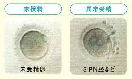 (未受精卵・3PN胚など)未受精卵は前核が確認できないもの。異常受精は前核が2つ以外のもの。