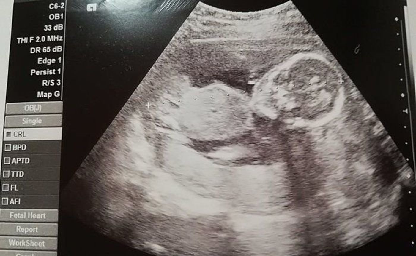 妊娠18週 赤ちゃんのエコー写真 超音波写真まとめ たまひよ 妊娠18週 赤ちゃんのエコー写真 超音波写真まとめ たまひよ