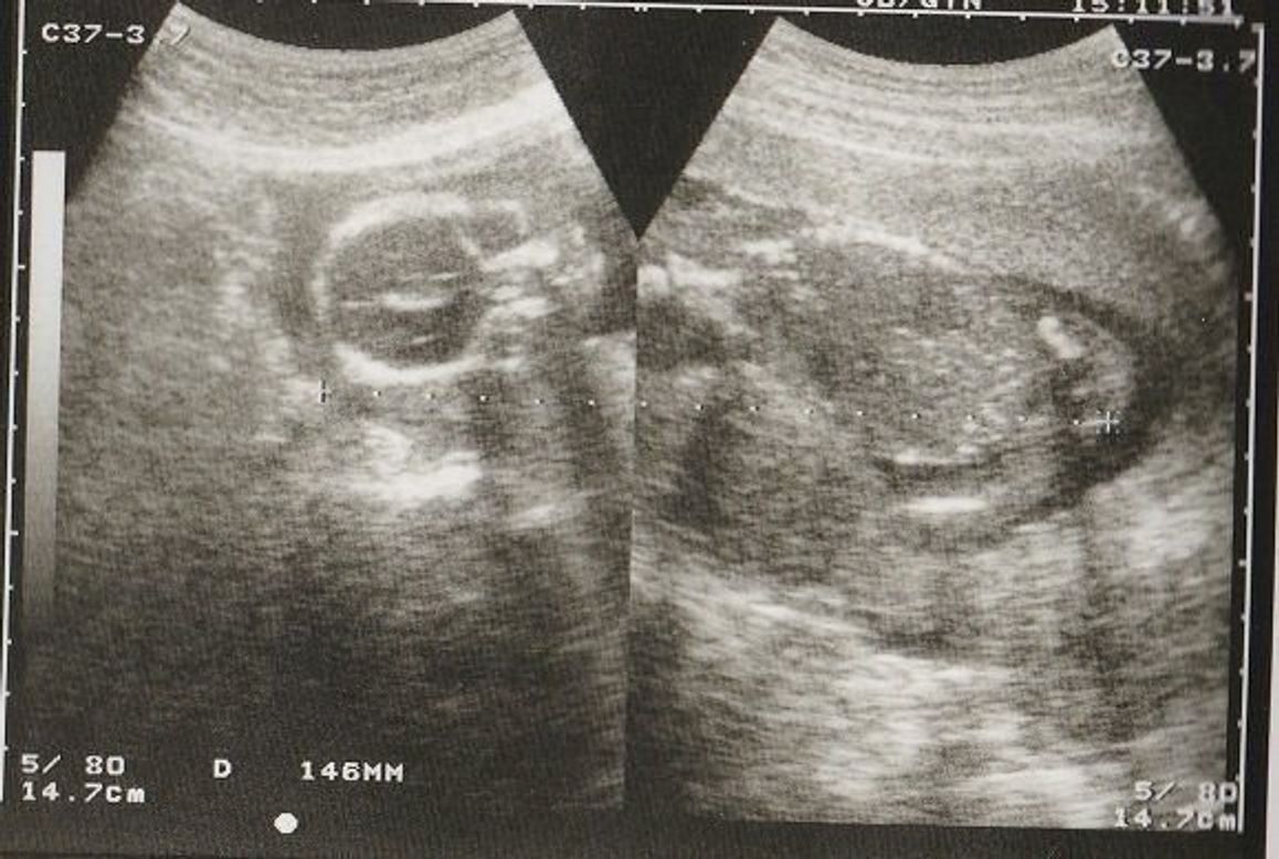 妊娠18週 赤ちゃんのエコー写真 超音波写真まとめ たまひよ 妊娠18週 赤ちゃんのエコー写真 超音波写真まとめ たまひよ