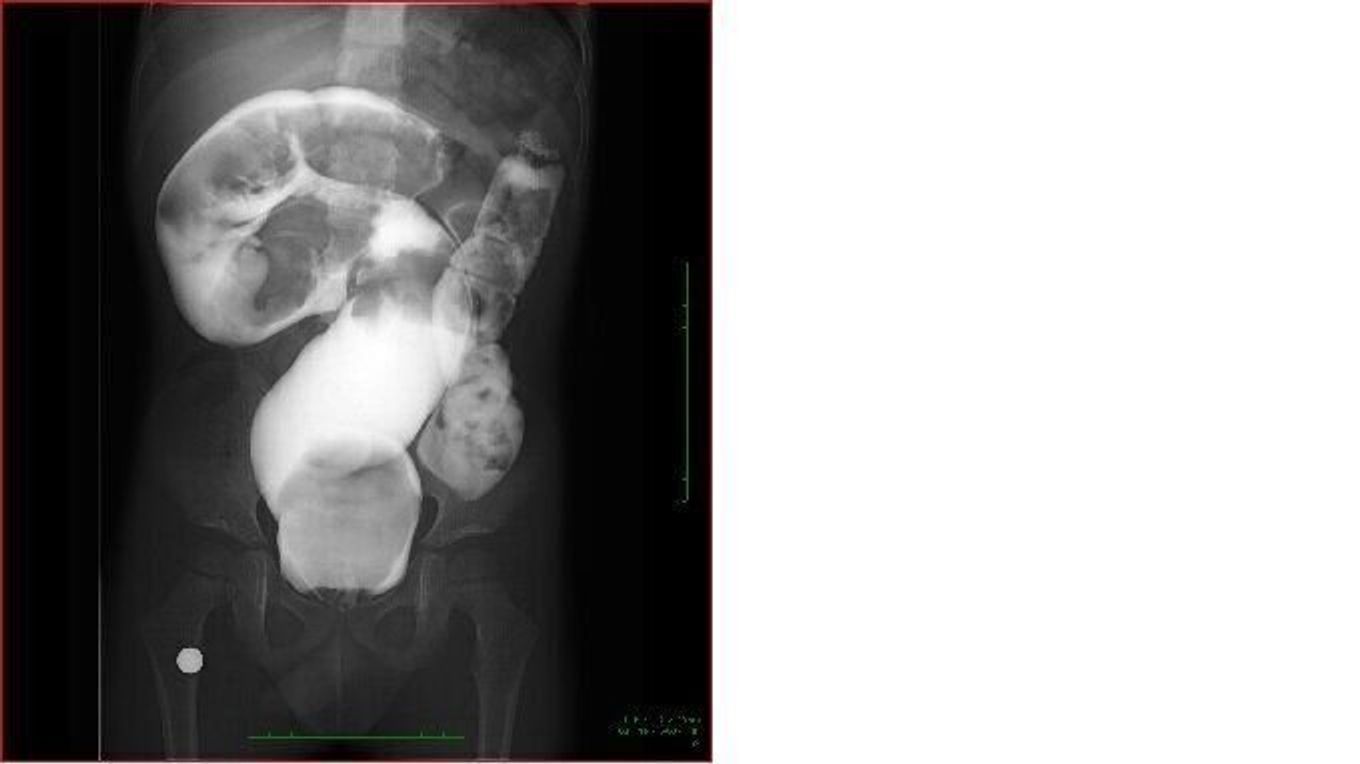 画像 小児慢性機能性便秘症と診断された子どもの腸のx線写真 たまひよ 画像 小児慢性機能性便秘症と診断された子どもの腸のx線写真 たまひよ