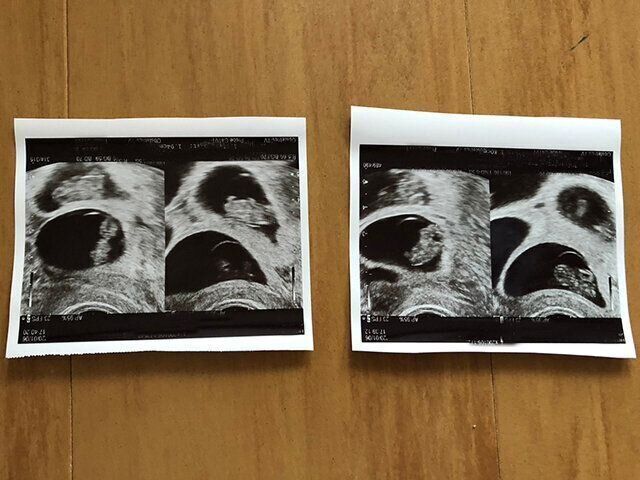 ４つ子妊娠出産体験談よつはさん　エコー写真