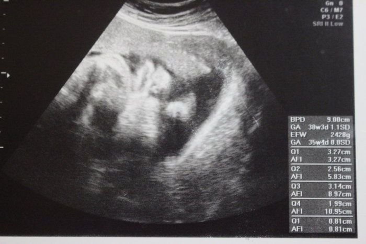 妊娠35週 赤ちゃんのエコー写真 超音波写真まとめ たまひよ 妊娠35週 赤ちゃんのエコー写真 超音波写真まとめ たまひよ