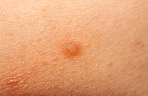 伝染性軟属属腫とも呼ばれる水疣贅のクローズアップ