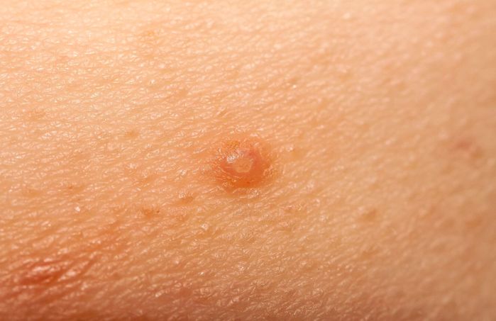 伝染性軟属属腫とも呼ばれる水疣贅のクローズアップ