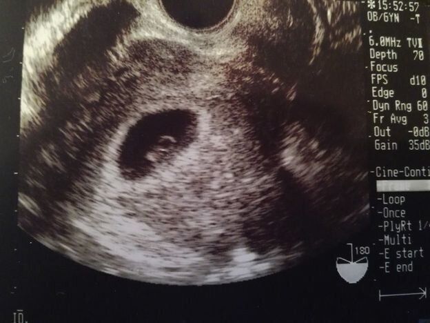 妊娠６週目のおなかの赤ちゃんはどう見える？ みんなのエコー写真・超音波写真｜たまひよ