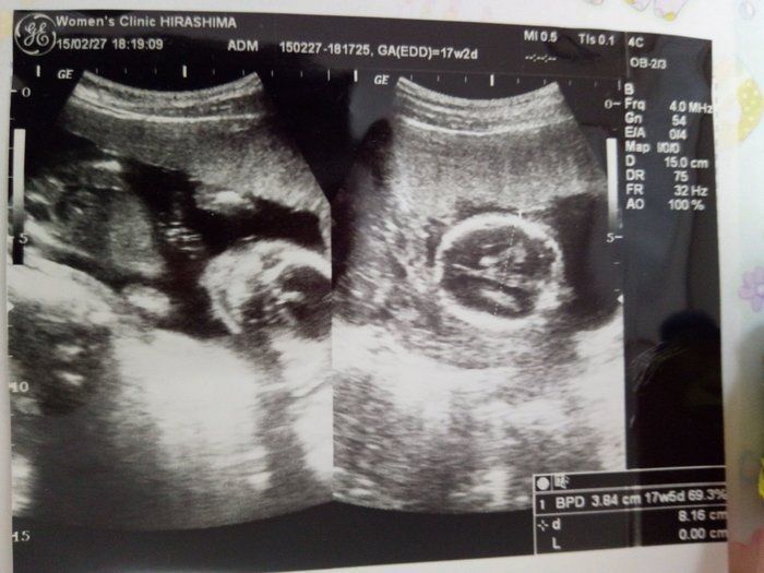 妊娠17週 赤ちゃんのエコー写真 超音波写真まとめ たまひよ