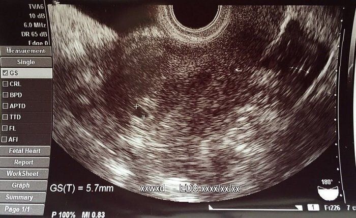 妊娠4週目のエコー写真