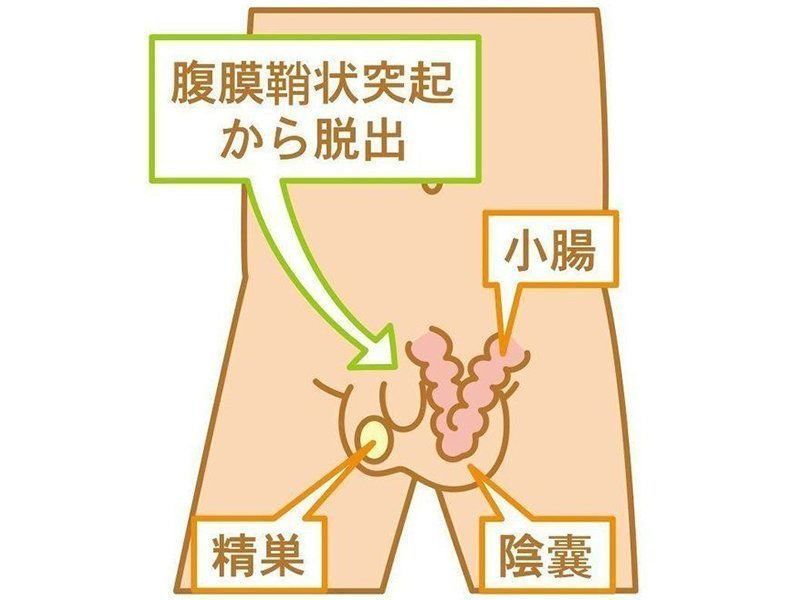 赤ちゃんのおなかの病気 鼠径ヘルニア 脱腸の症状とケア 医師監修 たまひよ