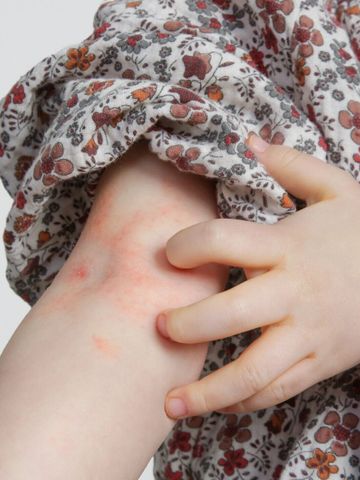 たかが虫刺され でも虫によっては命にかかわることも 小児科医が解説 たまひよ たかが虫刺され でも虫によっては命にかかわることも 小児科医が解説 たまひよ