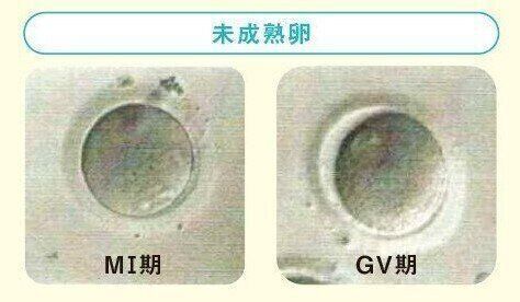（Ｍ1期卵・GV期）第1極体が出ていない卵は未成熟卵といい、体外受精や顕微授精に使用できません。