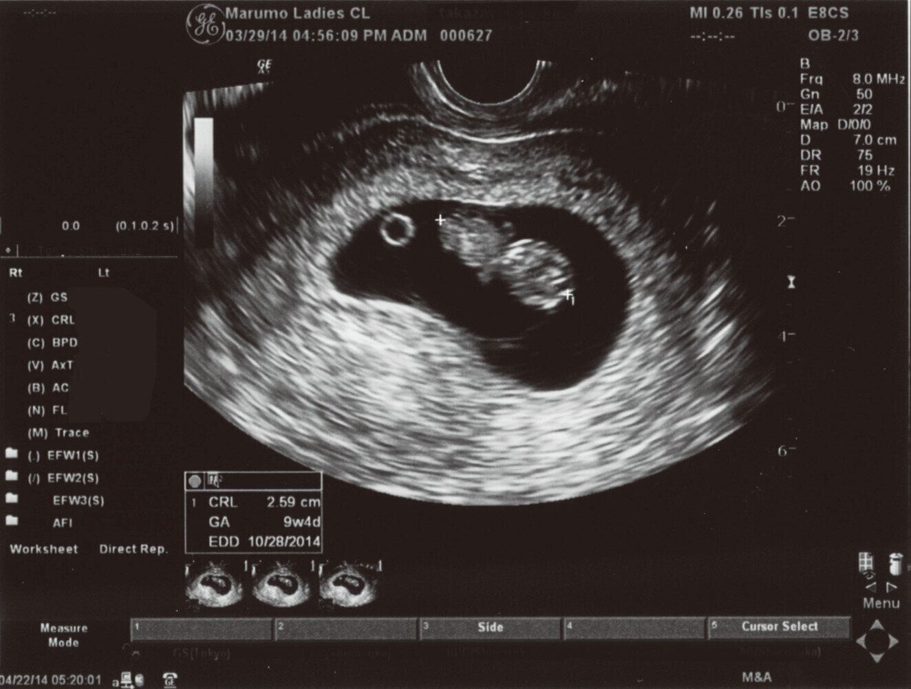 実際の超音波写真・エコー写真の画像