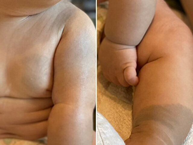 異所性蒙古斑レーザー治療体験談