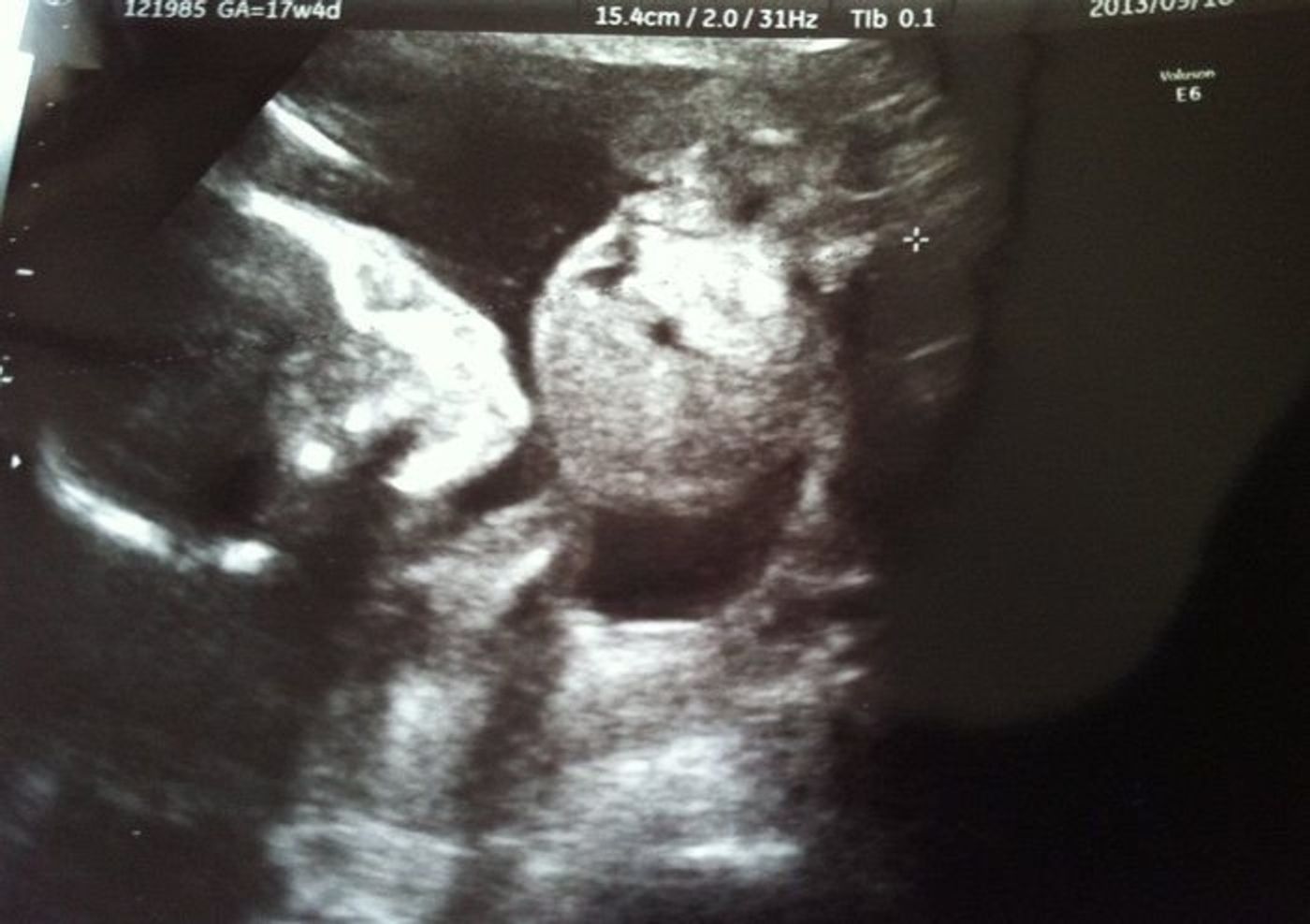 妊娠17週 赤ちゃんのエコー写真 超音波写真まとめ たまひよ 妊娠17週 赤ちゃんのエコー写真 超音波写真まとめ たまひよ
