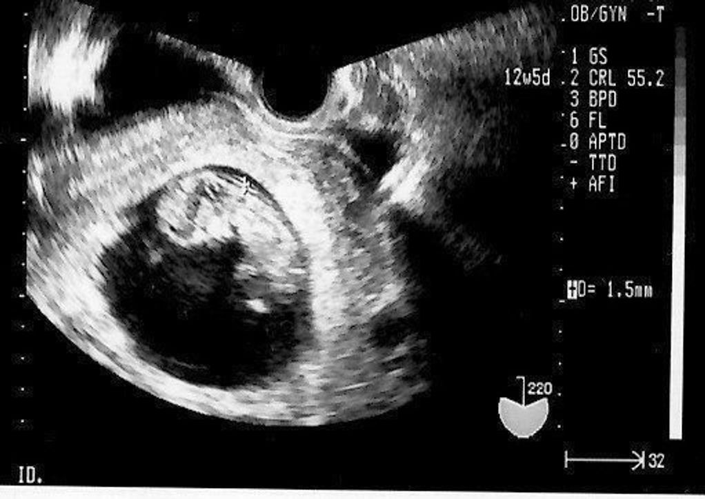妊娠12週 赤ちゃんのエコー写真 超音波写真まとめ たまひよ 妊娠12週 赤ちゃんのエコー写真 超音波写真まとめ たまひよ
