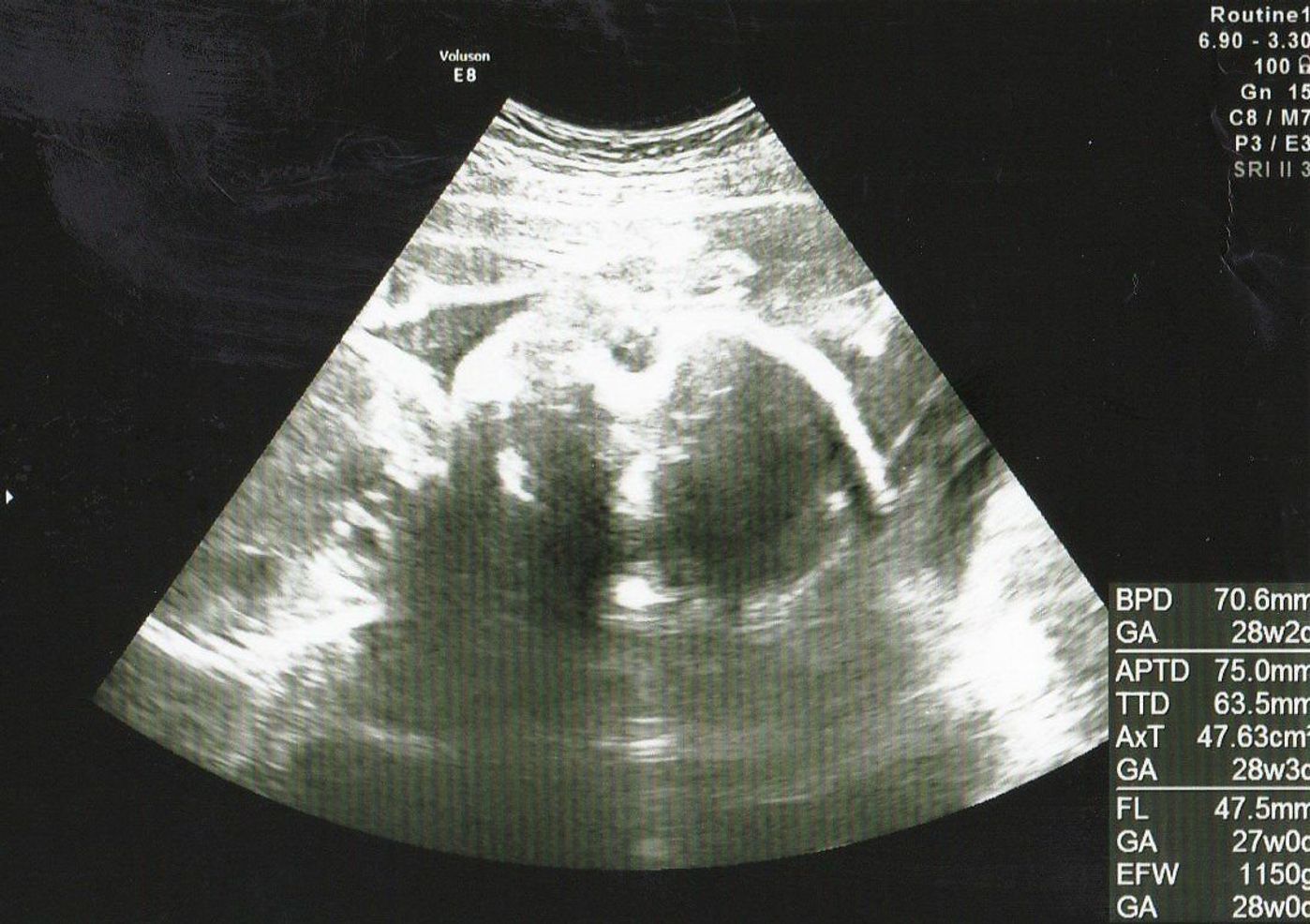 エコー画像で振り返る 私に宿った小さな命が大きく育って誕生するまでの記録 たまひよ エコー画像で振り返る 私に宿った小さな命が大きく育って誕生するまでの記録 たまひよ