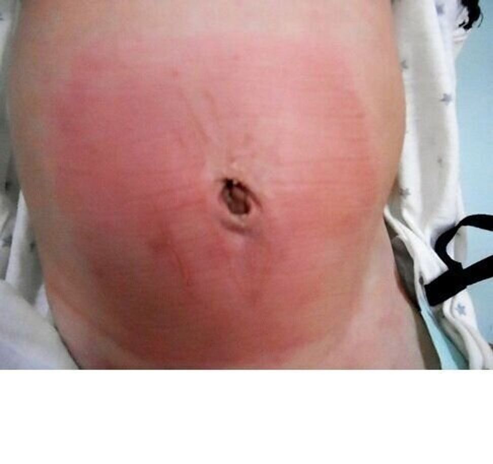 小児科医リレーエッセイ たかが されど でべそ 臍ヘルニアは早期治療できれいに治る たまひよ 小児科医リレーエッセイ たかが されど でべそ 臍ヘルニアは早期治療できれいに治る たまひよ