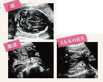 頭・腹部・太ももの長さがわかる超音波写真・エコー写真