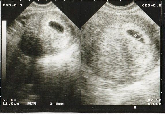 妊娠6週目のエコー写真