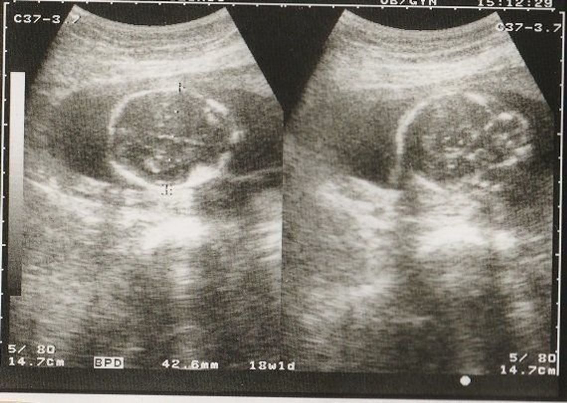 妊娠18週 赤ちゃんのエコー写真 超音波写真まとめ たまひよ 妊娠18週 赤ちゃんのエコー写真 超音波写真まとめ たまひよ