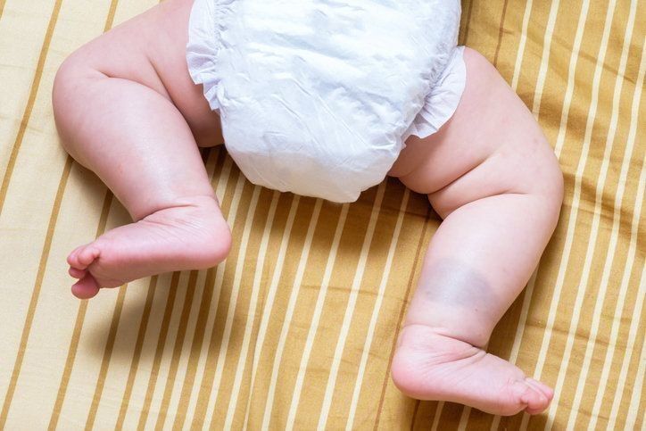 医師監修 赤ちゃんの あざ はなぜできる ほうっておいて大丈夫 ９症状を小児科医が解説 たまひよ