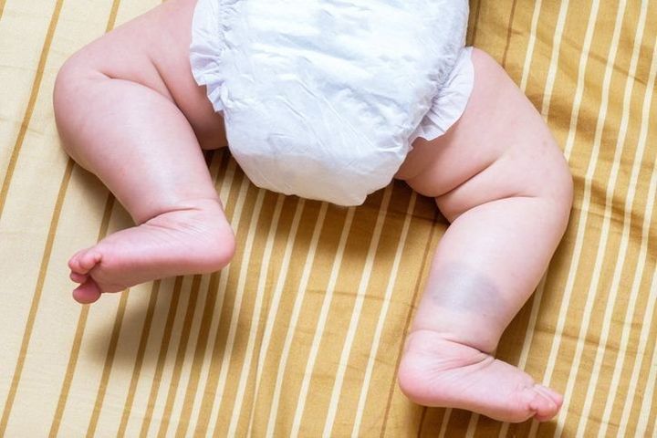 医師監修 赤ちゃんの あざ はなぜできる ほうっておいて大丈夫 9症状を小児科医が解説 たまひよ 医師監修 赤ちゃんの あざ はなぜできる ほうっておいて大丈夫 9症状を小児科医が解説 たまひよ