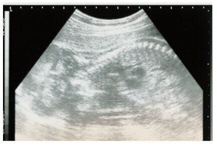 劣化した12年前の超音波写真・超音波写真の画像