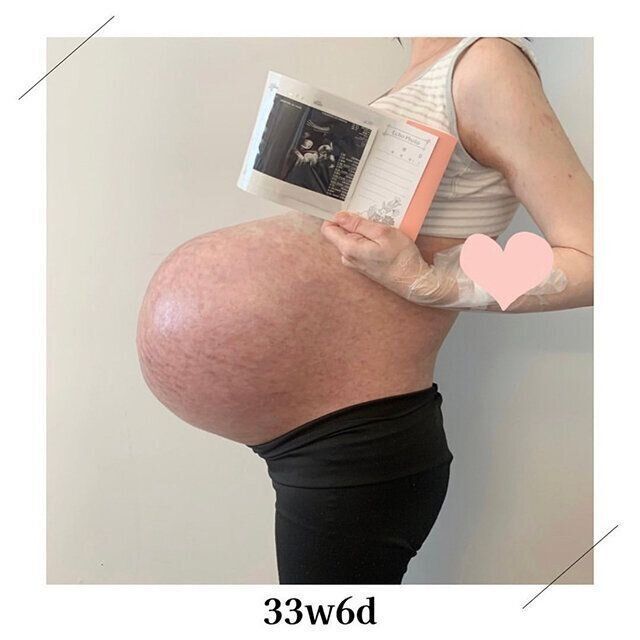 momoさん 3つ子育児体験談　妊娠中のおなか