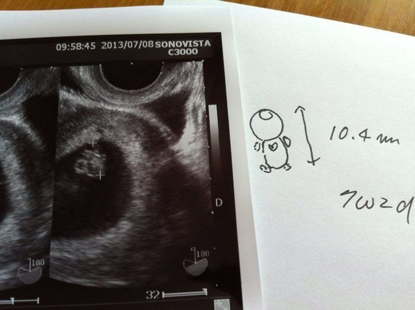 妊娠7週 赤ちゃんのエコー写真 超音波写真まとめ たまひよ 妊娠7週 赤ちゃんのエコー写真 超音波写真まとめ たまひよ