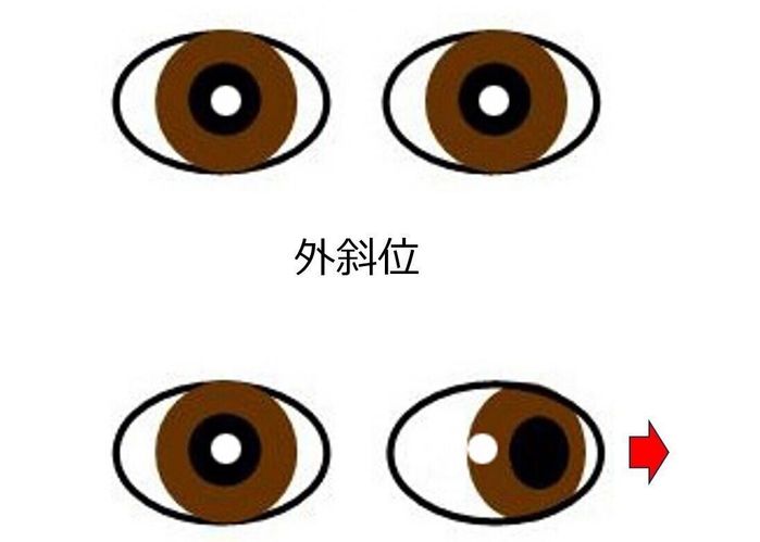 斜眼 と は, 斜視 見え方 画像 – 内斜視、特に急性内斜視について – PJHT