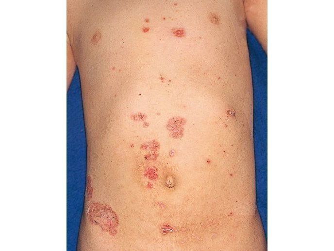 赤ちゃんの皮膚の病気 とびひ 伝染性膿痂疹の症状とケア 医師監修 たまひよ