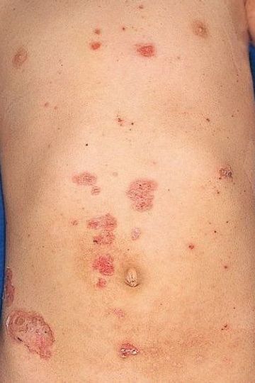 赤ちゃんの皮膚の病気 とびひ 伝染性膿痂疹の症状とケア 医師監修 たまひよ