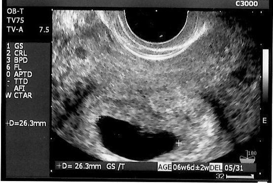 妊娠6週 赤ちゃんのエコー写真 超音波写真まとめ たまひよ