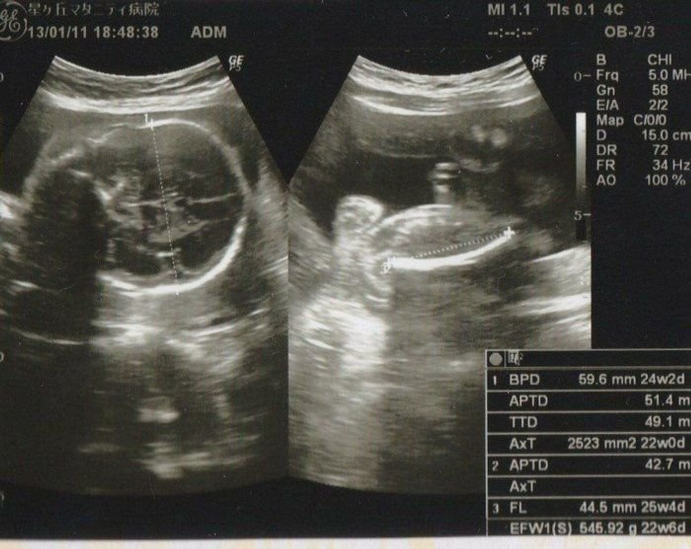 妊娠25週 赤ちゃんのエコー写真 超音波写真まとめ たまひよ 妊娠25週 赤ちゃんのエコー写真 超音波写真まとめ たまひよ