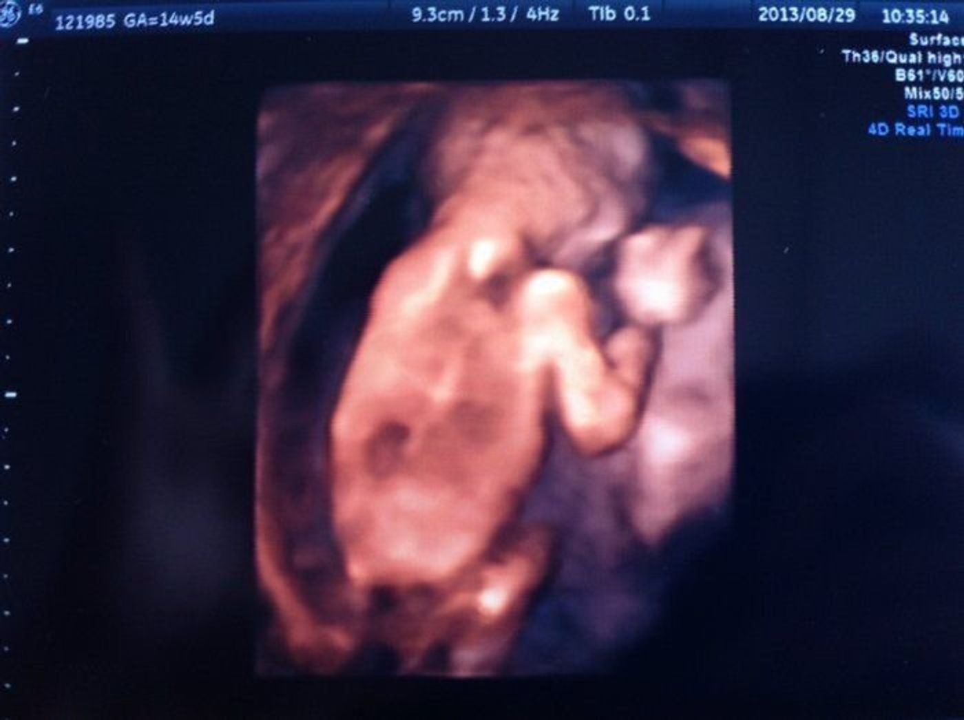妊娠14週 赤ちゃんのエコー写真 超音波写真まとめ たまひよ 妊娠14週 赤ちゃんのエコー写真 超音波写真まとめ たまひよ
