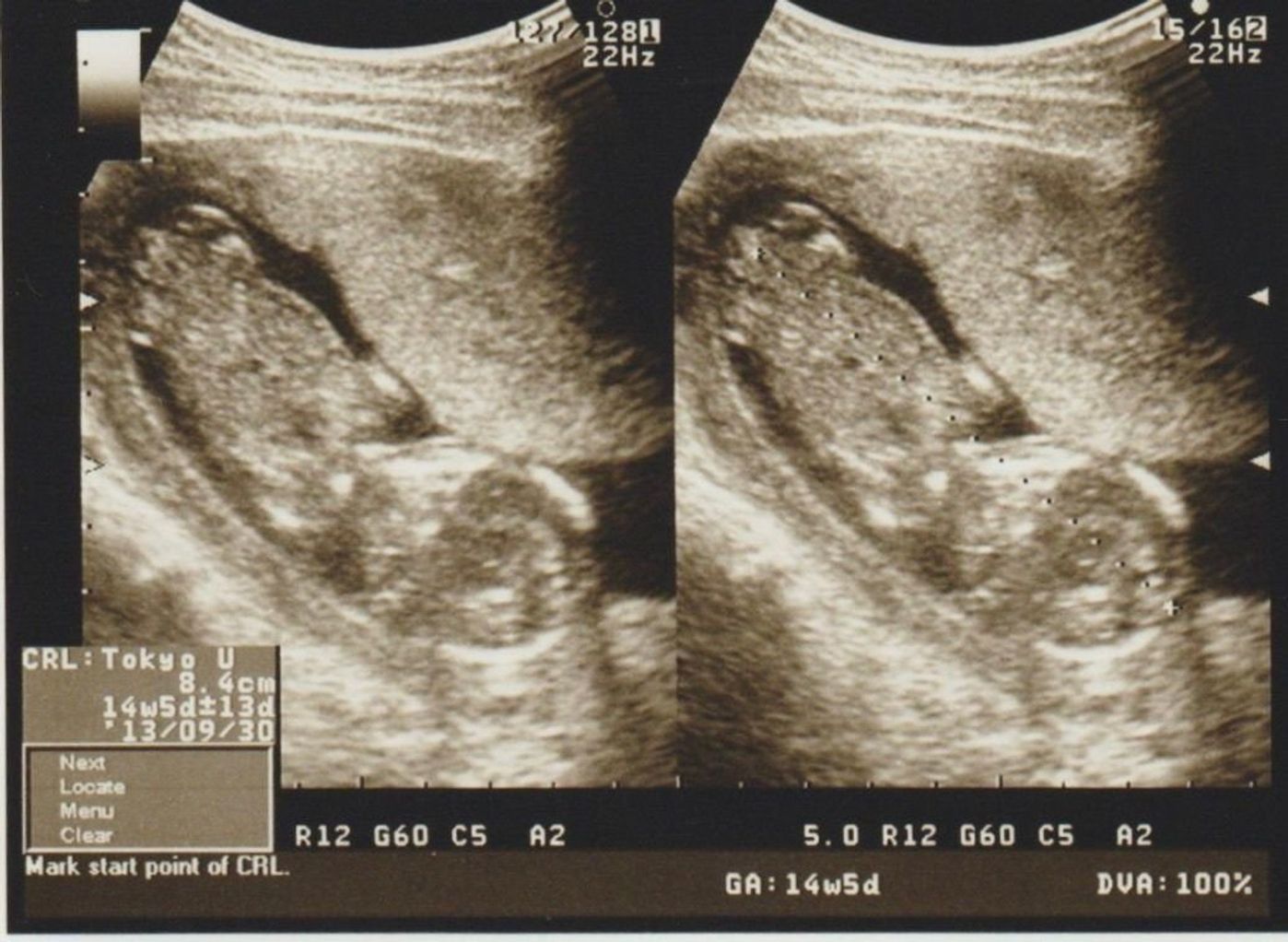 待望の妊娠判明 エコー写真に見る 我が子を胸に抱くまでの 命の軌跡275日 たまひよ 待望の妊娠判明 エコー写真に見る 我が子を胸に抱くまでの 命の軌跡275日 たまひよ