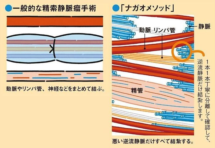 【精索静脈瘤】どんな手術をする?