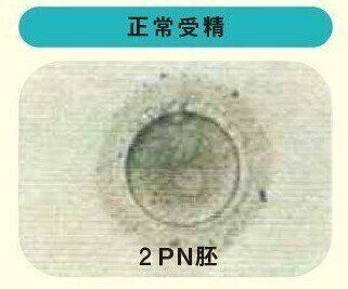 （2PN胚）採卵の翌日に受精確認を。卵子と精子からの前核（PN）が2つ確認できたものを正常受精といい、前核が確認できないものや、前核が2つ以外のものは原則用いません。