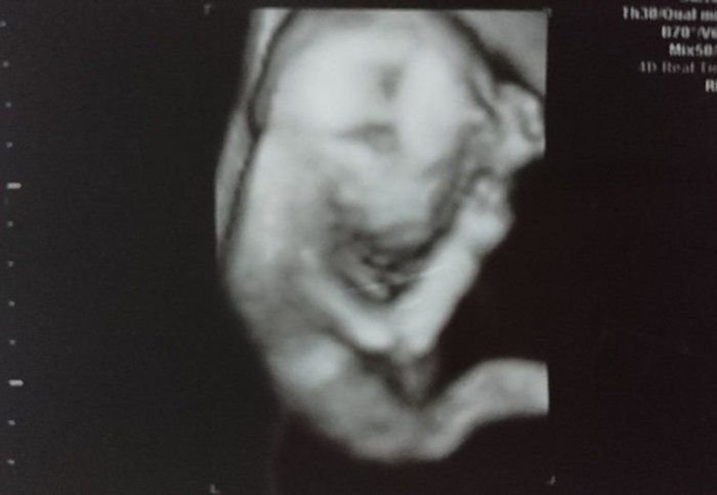 妊娠18週 赤ちゃんのエコー写真 超音波写真まとめ たまひよ 妊娠18週 赤ちゃんのエコー写真 超音波写真まとめ たまひよ