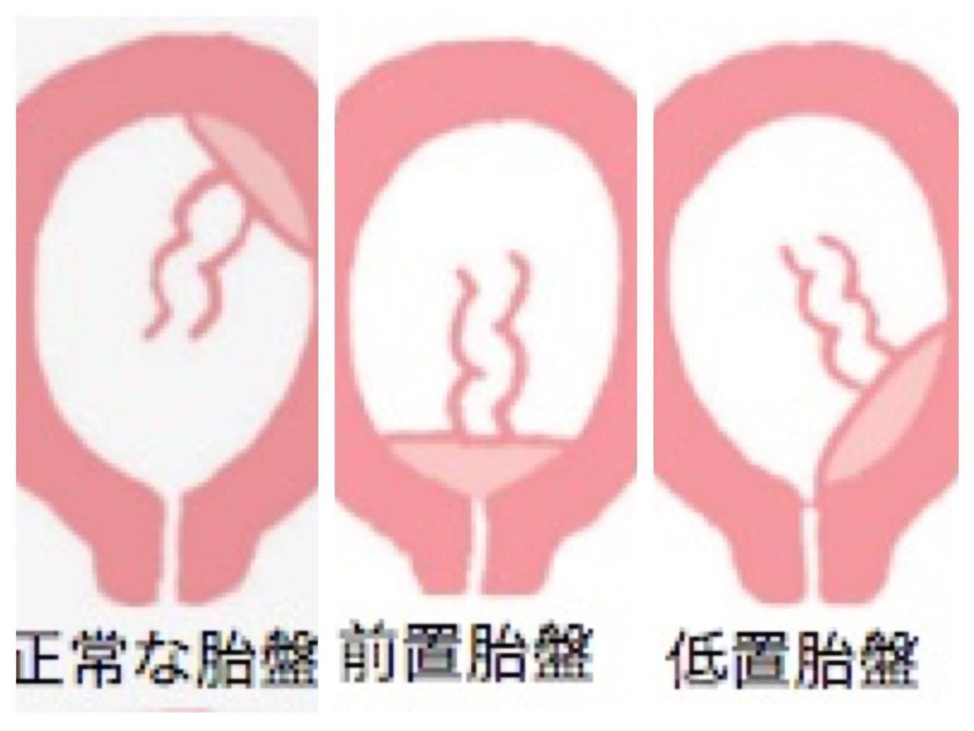 どれも危険度大 ママと赤ちゃんを結ぶ 胎盤 のトラブルを産婦人科医が解説 たまひよ どれも危険度大 ママと赤ちゃんを結ぶ 胎盤 のトラブルを産婦人科医が解説 たまひよ